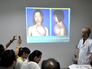 Médicos de um hospital em Fuzhou apresentam procedimento em que retiraram pele da perna de paciente para reconstituir um rosto em seu peito. (Foto: Reuters/China Daily)