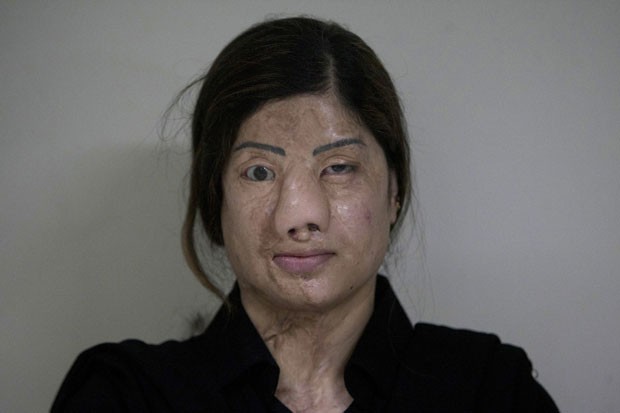 O cirurgião Asim Shahmalak gastou cerca de 50 mil libras (mais de R$ 200 mil) de seu próprio bolso para bancar as cirurgias. (Foto: Shakil Adil/AP Images for Crown Clinic)