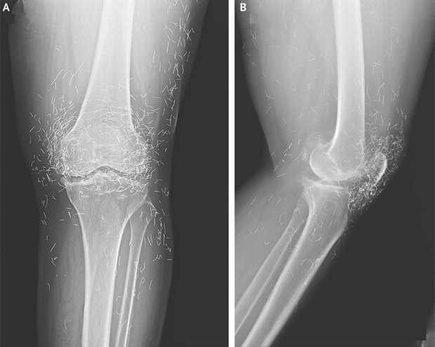Radiografia revelou centenas de fragmentos de agulhas presos a perna de senhora sul-coreana (Foto: Divulgação/New England Journal of Medicine)